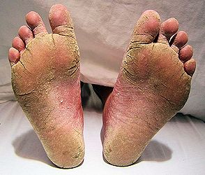 A severe case of athlete's foot.