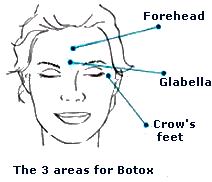 Areas treated by Botox