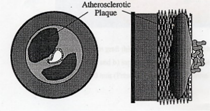 atheromatous plaques