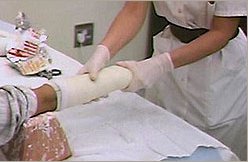 A nurse applying a plaster (gypsum) cast