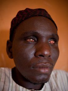 A sufferer of river blindness