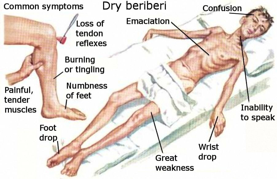 Some symptoms of ‘dry’ beriberi