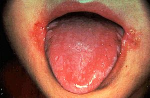 Beefy tongue caused by riboflavin deficiency
