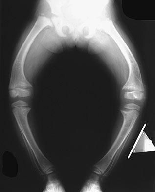 x-ray of child with rickets