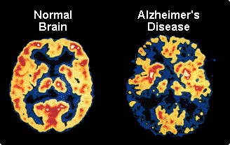 Comparison of a normal brain with an Alzheimer's patient (used wihout permision)