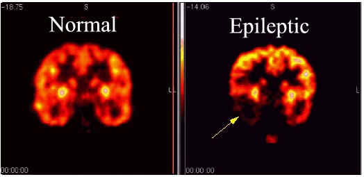 Comparision of a healthy brain with an eplieptic brain (used without permission)