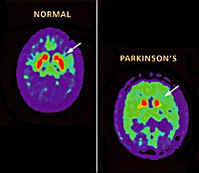 Comparison of a healthy brain with a Parkinson's patient (used without permission)