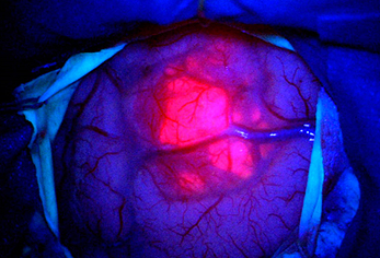 Brain tumour cells fluorescing bright pink after 5-ALA ingestion before surgery
