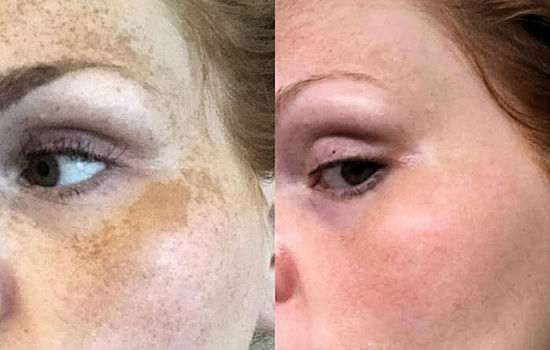 Melasma treated with AzA, before and after