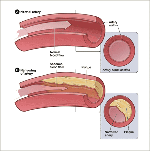 atherosclerosis