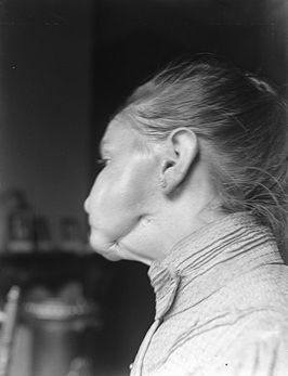 Woman with 'phossy jaw'