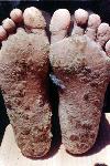 Skin lesions on the feet caused by arsenic poisoning