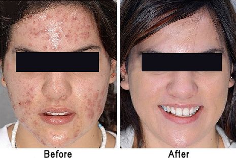 Photos of a teenage girl with acne before and after using a benzoyl peroxide based cream