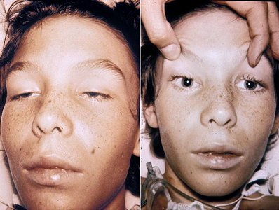 A boy with botulism