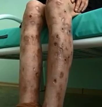 Skin ulcers caused by krokodil use