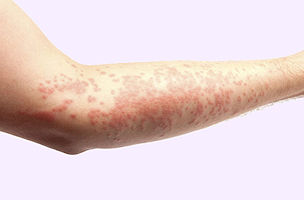 Allergic reaction on the skin