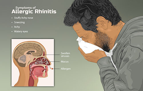 Sneezing due to allergy