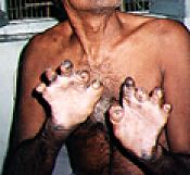 A leprosy victim