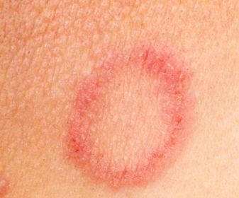 Ringworm rash