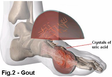 Gout