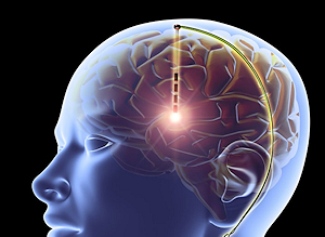 Diamond brain implant