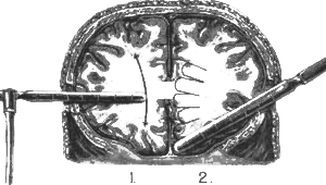Prefrontal lobes of the cortex of the brain