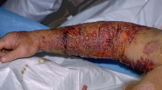 Snake bite